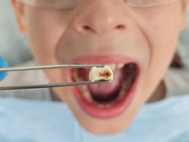 Best Emergency Dental Care for Broken or Chipped Teeth in Cypress Lake, FL